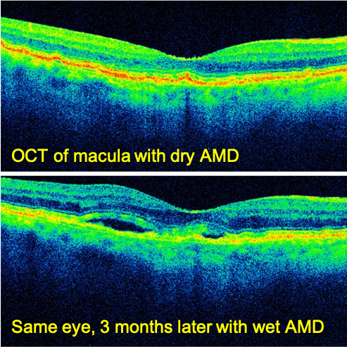 dry wet AMD gm